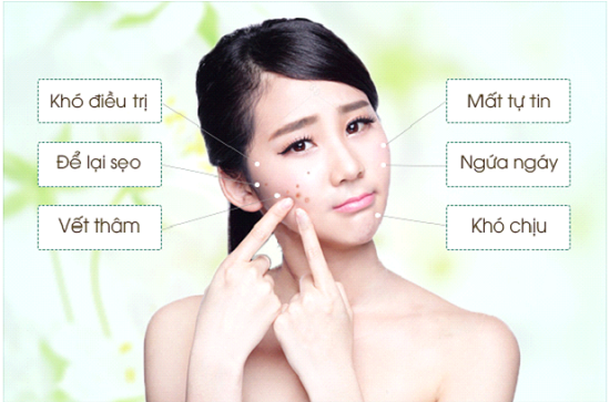 cách trj mụn ở tuổi dạy thì
