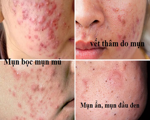 Tea Tree Oil Trị Mụn