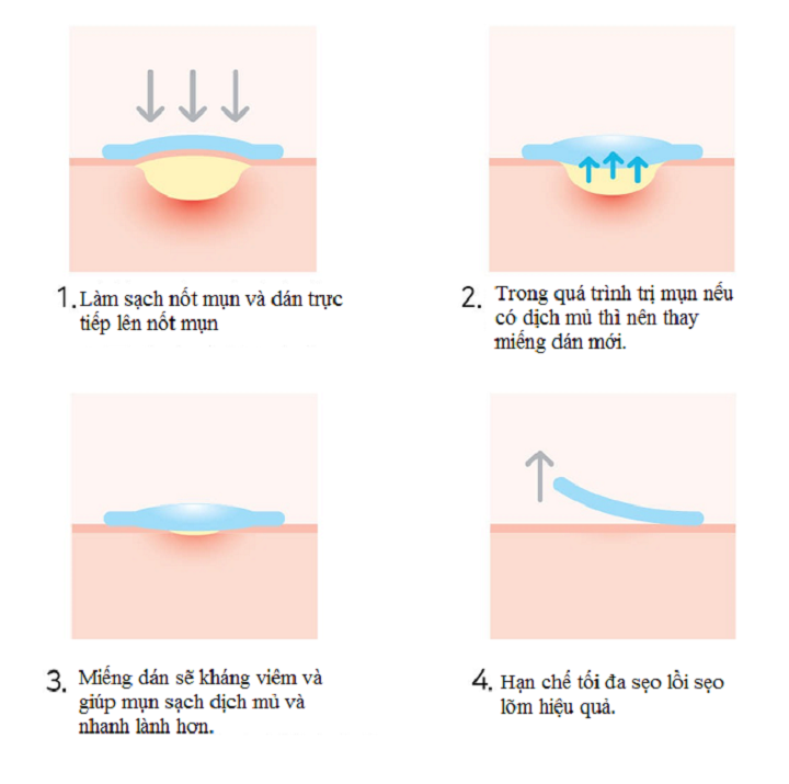 mieng-dan-tri-mun-boc-mun-mu-han-quoc